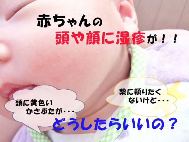 新生児や赤ちゃんの湿疹 頭や顔にできたらどうしたらいいの Conamiのおすすめブログ